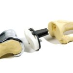 knee replacement hardware Revolutionizing Mobility Solutions